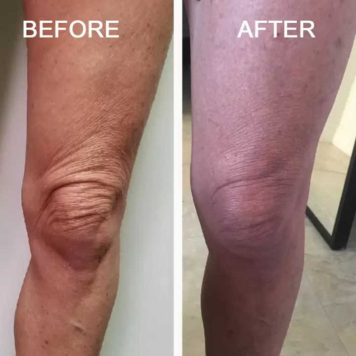 Successful experience in treating arthritis from beans