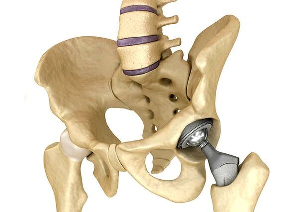 EndoProsthetica hook hip