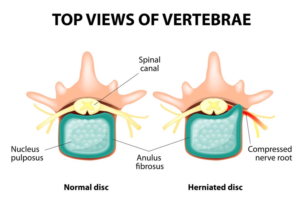 Healthy intervertebral disk and hernia
