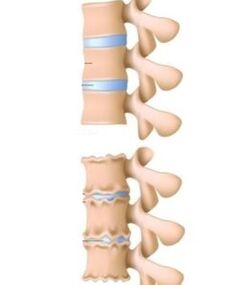 Causes of osteochondrose