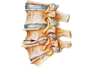 Signs and symptoms of osteochondrose