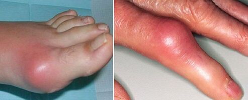 the appearance of arthritic joints