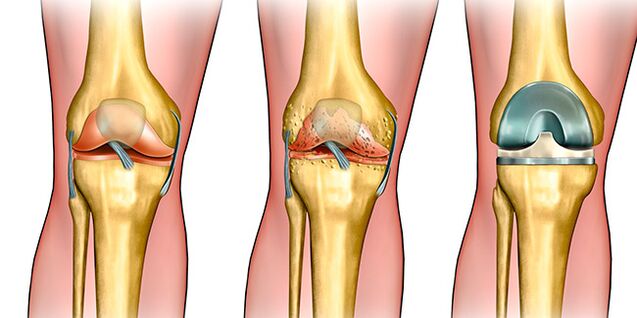 In the third stage of arthrosis, knee replacement is required