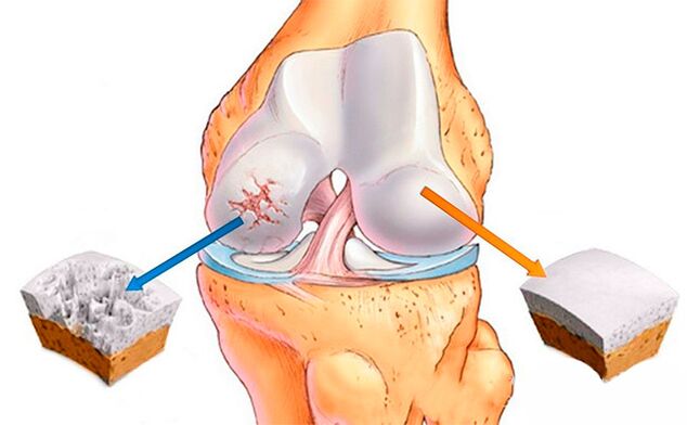 Normal knee joint (right) and joint affected by arthrosis (left)