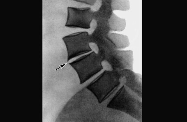 Manifestations of osteochondrosis of the thoracic spine on X-ray