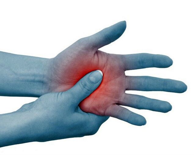 Severe pain in the joints of the fingers, which is reduced by exercise, is a typical sign of rheumatoid arthritis. 